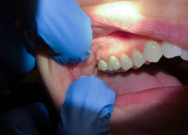 Best Emergency Dental Care for Abscessed Tooth in Fulshear, TX