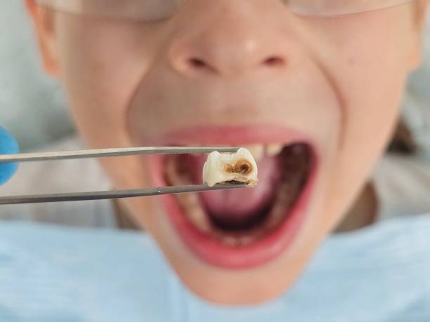 Best Emergency Dentist for Lost Fillings or Crowns in Fulshear, TX